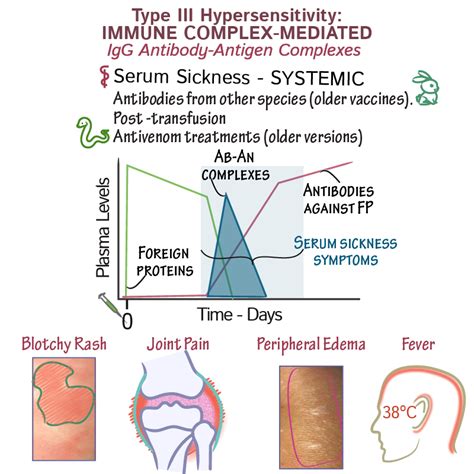 Pathology Glossary: Serum Sickness | Draw It to Know It