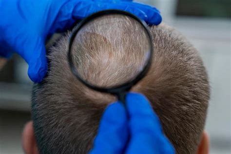 Folliculitis decalvans, what are the symptoms? - Hairfix