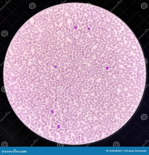 Normochromic and Normocytic Rbc Blood Smear Stock Photo - Image of ...