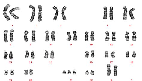 A karyotype of a Down syndrome patient (47, XX,+21) (Reproduced... | Download Scientific Diagram