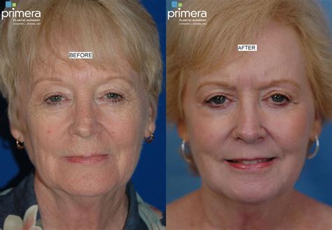 Chemical Peel for Orlando & Winter Park, FL | Primera Plastic Surgery