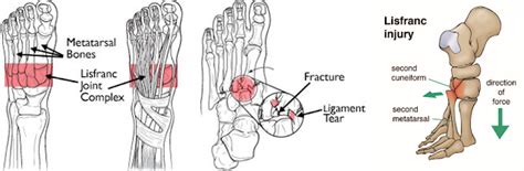 Lisfranc injury: A runners worst nightmare: The Lisfranc injury: Symptoms, Diagnosis, and ...