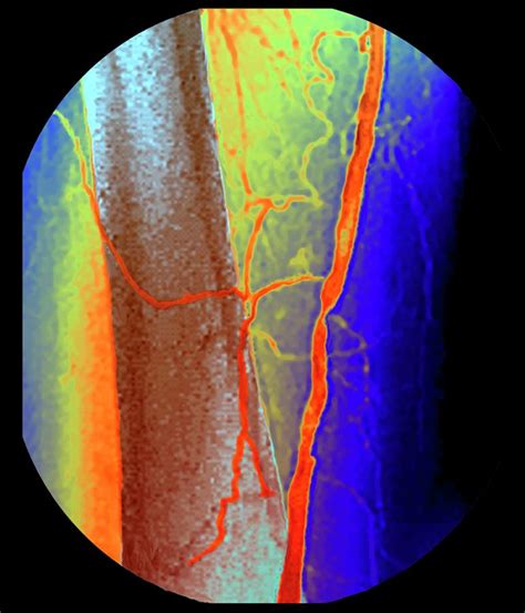 Femoral Artery Narrowing Photograph by Zephyr/science Photo Library