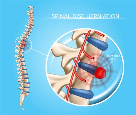 Herniated Disc Surgery: Types, Recovery Time, Risks and Benefits for Back Pain