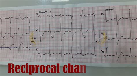 Reciprocal Changes in ECG - YouTube