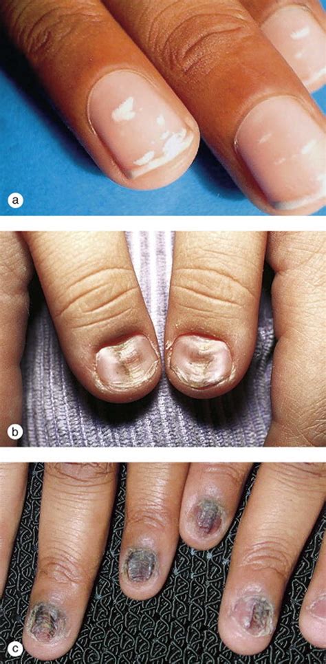 Nail dystrophy definition, causes & treatment