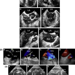 Patient with aortic regurgitation with Austin Flint diastolic murmur.... | Download Scientific ...