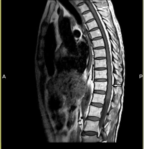 Intramedullary spinal cord metastasis | Eurorad