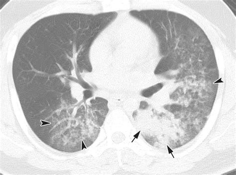 Radiographic and CT Features of Viral Pneumonia | RadioGraphics