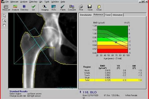 Osteoporosi: cos'è e come funziona la MOC/DEXA? - Noodsituatie Live