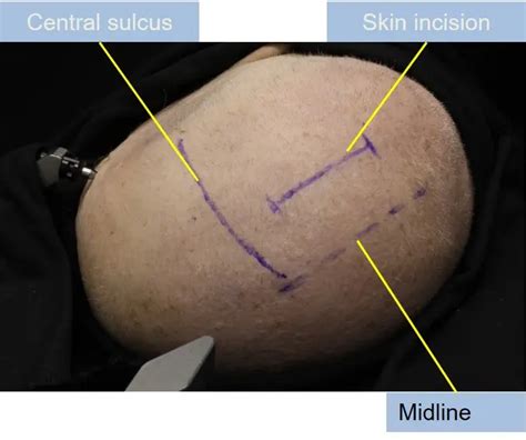 Superior Parietal Lobule Approach - cns.org