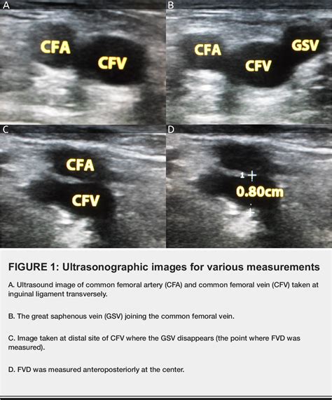 Figure 1 from Predicting Central Venous Pressure by Measuring Femoral Venous Diameter Using ...