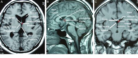 [PDF] A classification of lesions around interventricular foramen and ...