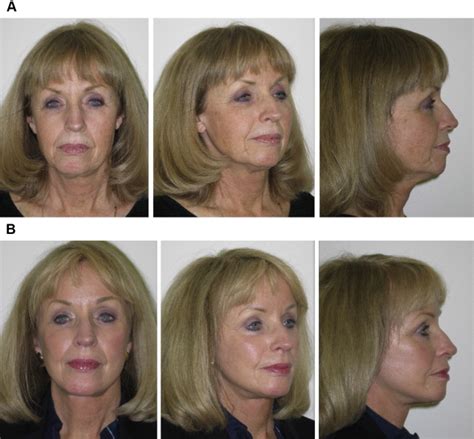 The Deep-Plane Approach to Neck Rejuvenation | Plastic Surgery Key