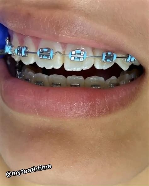 baby blue chain braces - Kasi Snowden