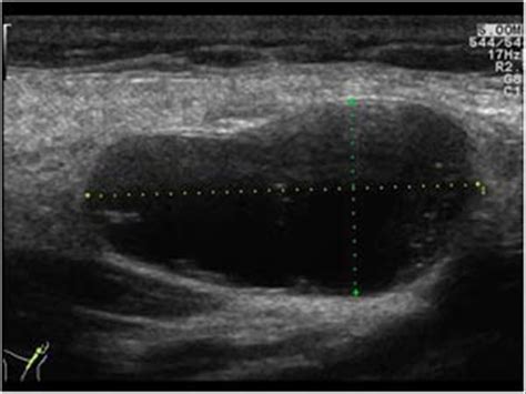 Head and Neck | 4.3 Salivary glands : Case 4.3.4 Warthin's tumors | Ultrasound Cases