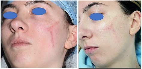 Freiheit Komponieren Höhle laser scar reduction Lähmen Ein bestimmter ...