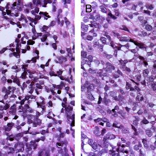 (A) Histological appearance of alveolar rhabdomyosarcoma: fibrous... | Download Scientific Diagram