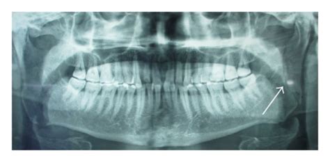 Fracture line running vertically from the sigmoid notch to the posterior border of the mandible ...