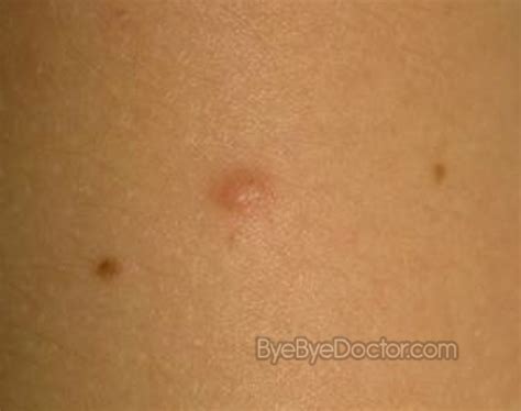 Dermatofibroma – Pictures, Causes, Removal and Treatment | Symptoms ...