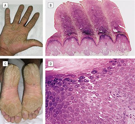 Diffuse Nonepidermolytic Palmoplantar Keratoderma Caused by a Recurrent Nonsense Mutation in ...