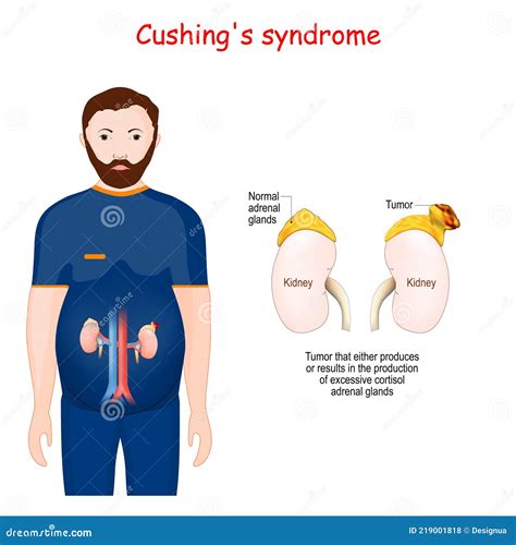 Cushing Cartoons, Illustrations & Vector Stock Images - 783 Pictures to ...