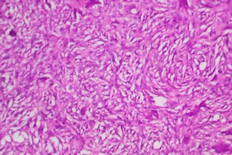 Histiocytoma Histology