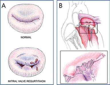 Chronic Mitral Valve Insufficiency in Dogs: Recent Advances in Diagnosis and Treatment | IntechOpen