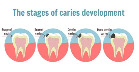 Stages of tooth caries stock illustration. Illustration of loose - 28522034