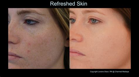 Freckles Are Signs – Charmed Medispa