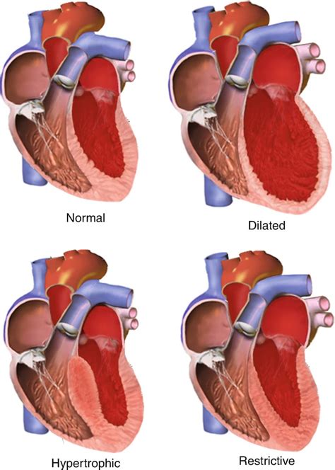 Cardiomyopathy - Center for Advanced Cardiac and Vascular Interventions