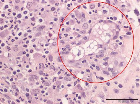 Sebaceous adenitis in a dog | Case Study | Cytopath