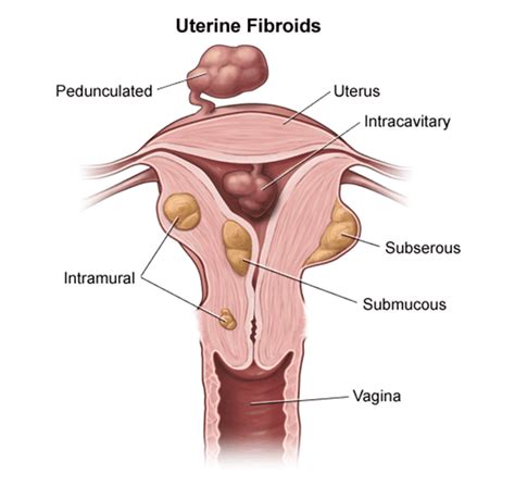 What Happens If You Get Pregnant 2 Months After Myomectomy