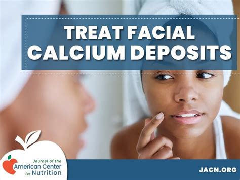 Treatments for Calcium Deposits on the Face - Facial Calcinosis Cutis: Causes, Symptoms, and ...