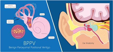 Vertigo Treatment: Causes, Relief, Treatment | SportsCare PT