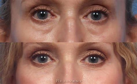 Under Eye Rejuvenation Photos • Rejuvent