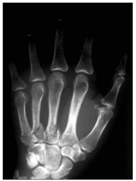 Metacarpal Fractures – Core EM