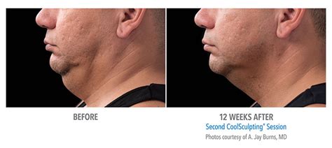 CoolSculpting Chin before and after, Double Chin Fat Freezing near me UK