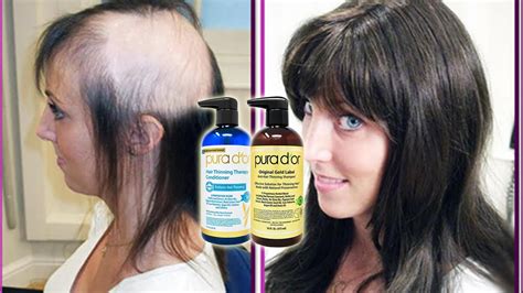 Best Hair Loss Shampoo 2021 - The Ultimate Solution! - YouTube