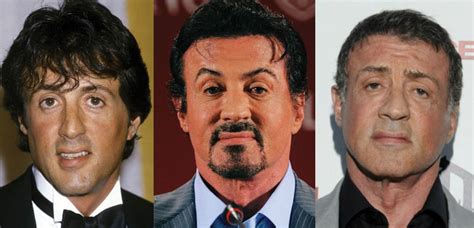 Sylvester Stallone Plastic Surgery Before and After Pictures 2024