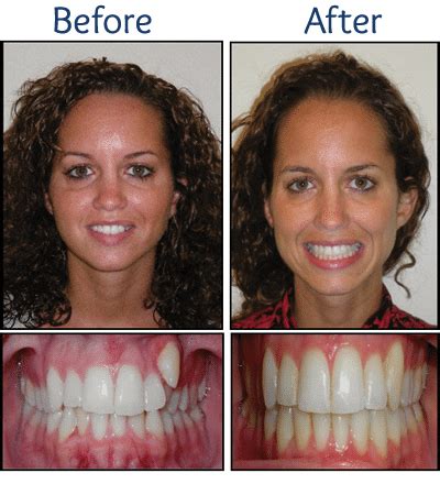 Invisalign Before and After Pictures in Atlanta, GA - Smile Envy Dental & Orthodontics