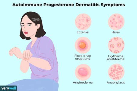 Allergic Reactions Related to the Menstrual Cycle