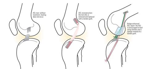 Bridge-Enhanced ACL Repair Archives ⋆ Ski Canada Magazine