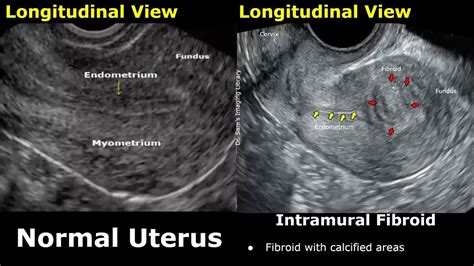 Uterus Ultrasound Normal Vs Intramural Fibroid Images | Uterine Leiomyomas USG Cases - YouTube