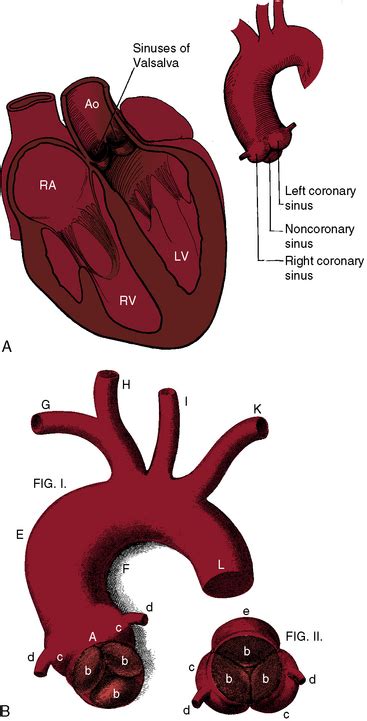 Congenital Aneurysms of the Sinuses of Valsalva | Thoracic Key