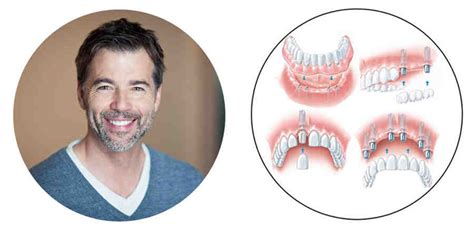 How do one day dental implants work - Dental News Network