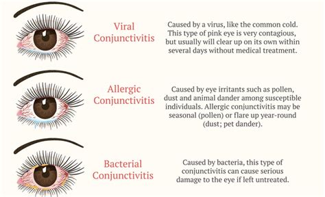 Pink Eye Symptoms: Causes And Treatment of Conjunctiva