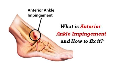 Anterior Ankle Impingement Syndrome