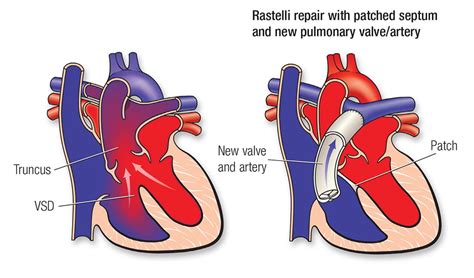 Truncus Arteriosus | American Heart Association