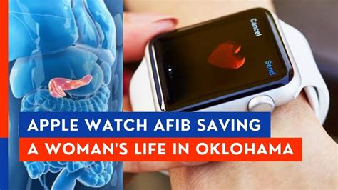 Apple Watch AFib alert leads to diabetes diagnosis, saving a woman's ...